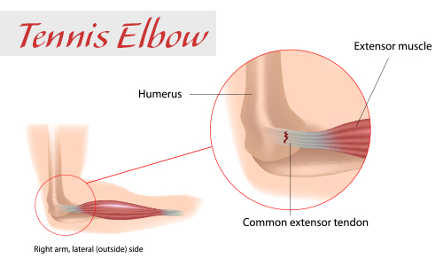 elbow anatomy for tennis elbow