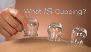 What is cupping main image for blog