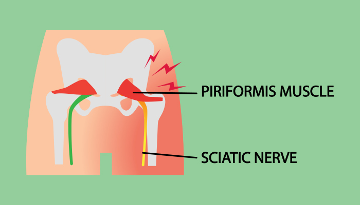piriformis muscle and sciatic nerve