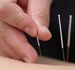 acupuncture-home