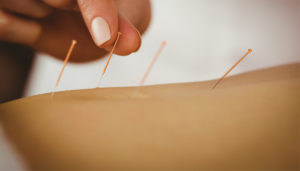 Acupuncture needles