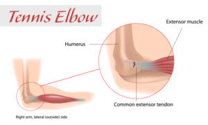 elbow anatomy for tennis elbow