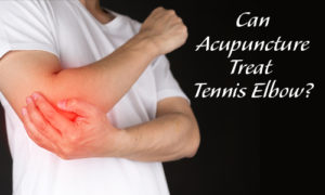 Can Acupuncture Treat Tennis Elbow