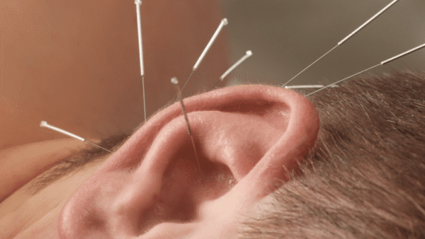 Ear Acupuncture
