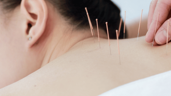 Acupuncture and Chiropractic Care