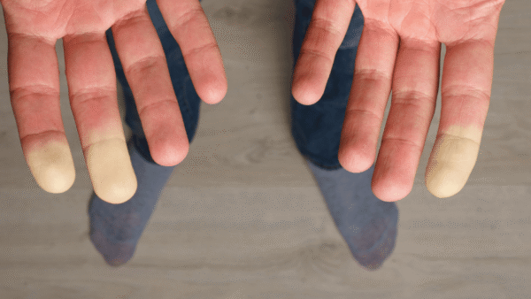 Raynaud’s Syndrome