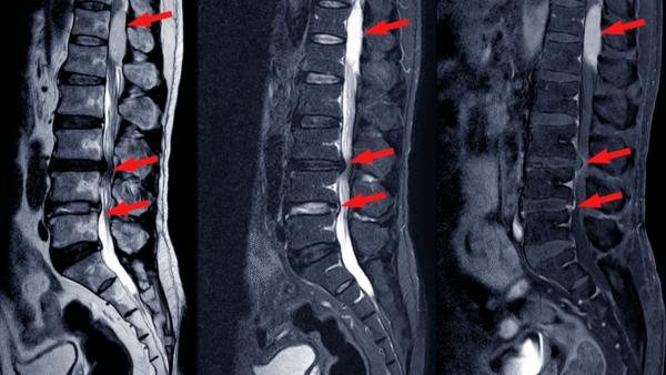 spinal stenosis